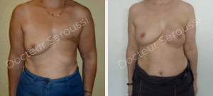 Avant-après - reconstruction mammaire - Dr Seroussi