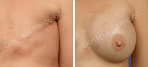 Avant-après - reconstruction mammaire - Dr Seroussi