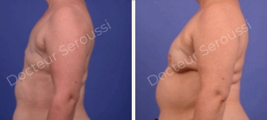 Avant-après - reconstruction mammaire - Dr Seroussi