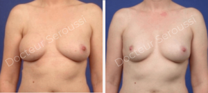 Avant-après - reconstruction mammaire - Dr Seroussi