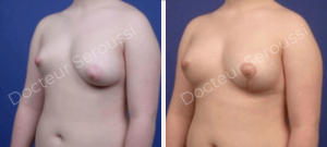 Avant-après - asymétrie mammaire - Dr Seroussi