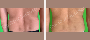 avant-après - lipoaspiration - Dr Seroussi