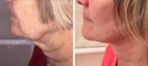 Avant - après - Génioplastie - Dr Seroussi