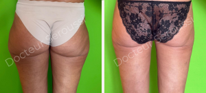 avant-après - lipoaspiration - Dr Seroussi