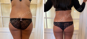 avant-après - lipoaspiration - Dr Seroussi