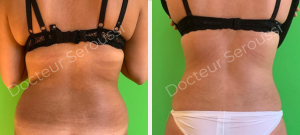 avant-après - lipoaspiration - Dr Seroussi