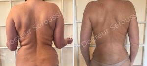 avant-après - lipoaspiration - Dr Seroussi