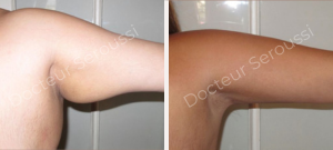Avant-Après - Plastie bras - Dr D.E Seroussi