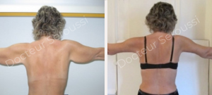 Avant-Après - Plastie bras - Dr D.E Seroussi