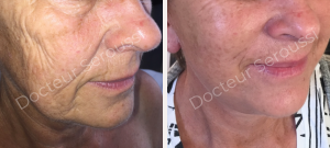 Avant - après - Génioplastie - Dr Seroussi