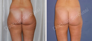 avant-après - lipoaspiration - Dr Seroussi