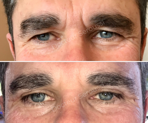 Avant - après - Paupières - Dr Seroussi