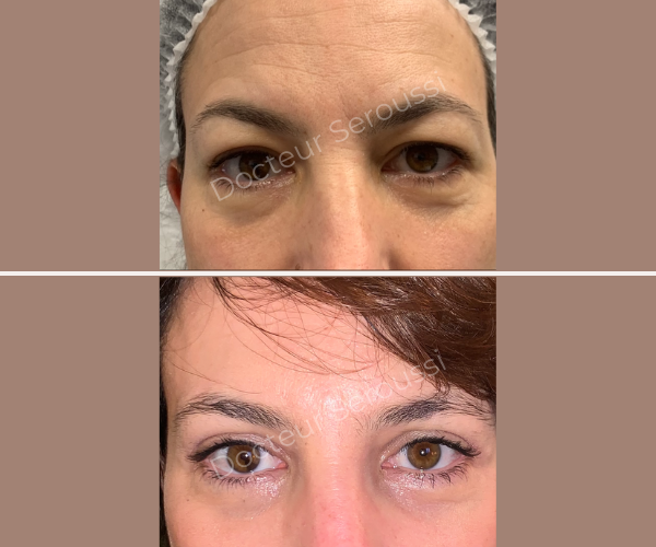 Avant - après - Paupières - Dr Seroussi