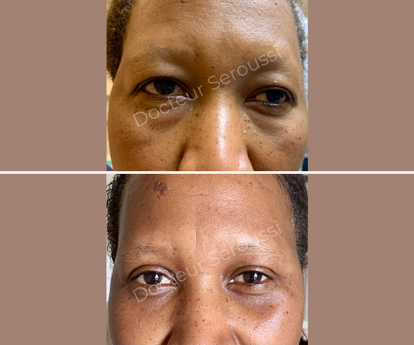 Avant - après - Paupières - Dr Seroussi