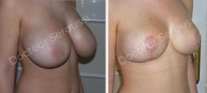 Réduction mammaire