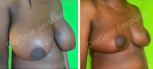 Réduction mammaire