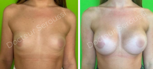 Avant-après - prothèse mammaire - Dr Seroussi