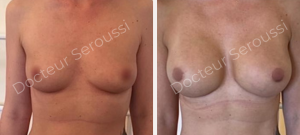 Avant-après - prothèse mammaire - Dr Seroussi