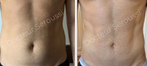 avant-après - lipoaspiration - Dr Seroussi